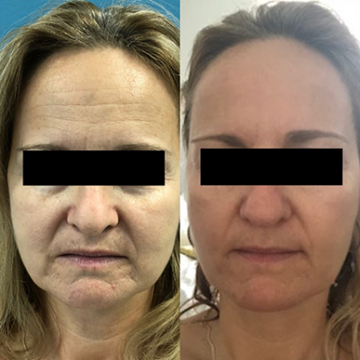 Thread Lift – Face Lift procedures in Toronto & Mississauga