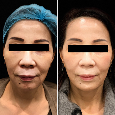 Thread Lift – Face Lift procedures in Toronto & Mississauga