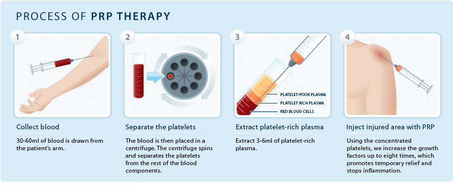 Platelet Rich Plasma Injection