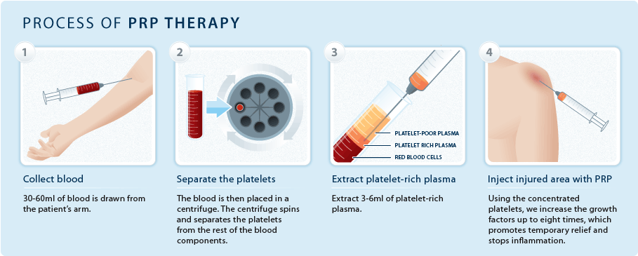 Platelet Rich Plasma Injection